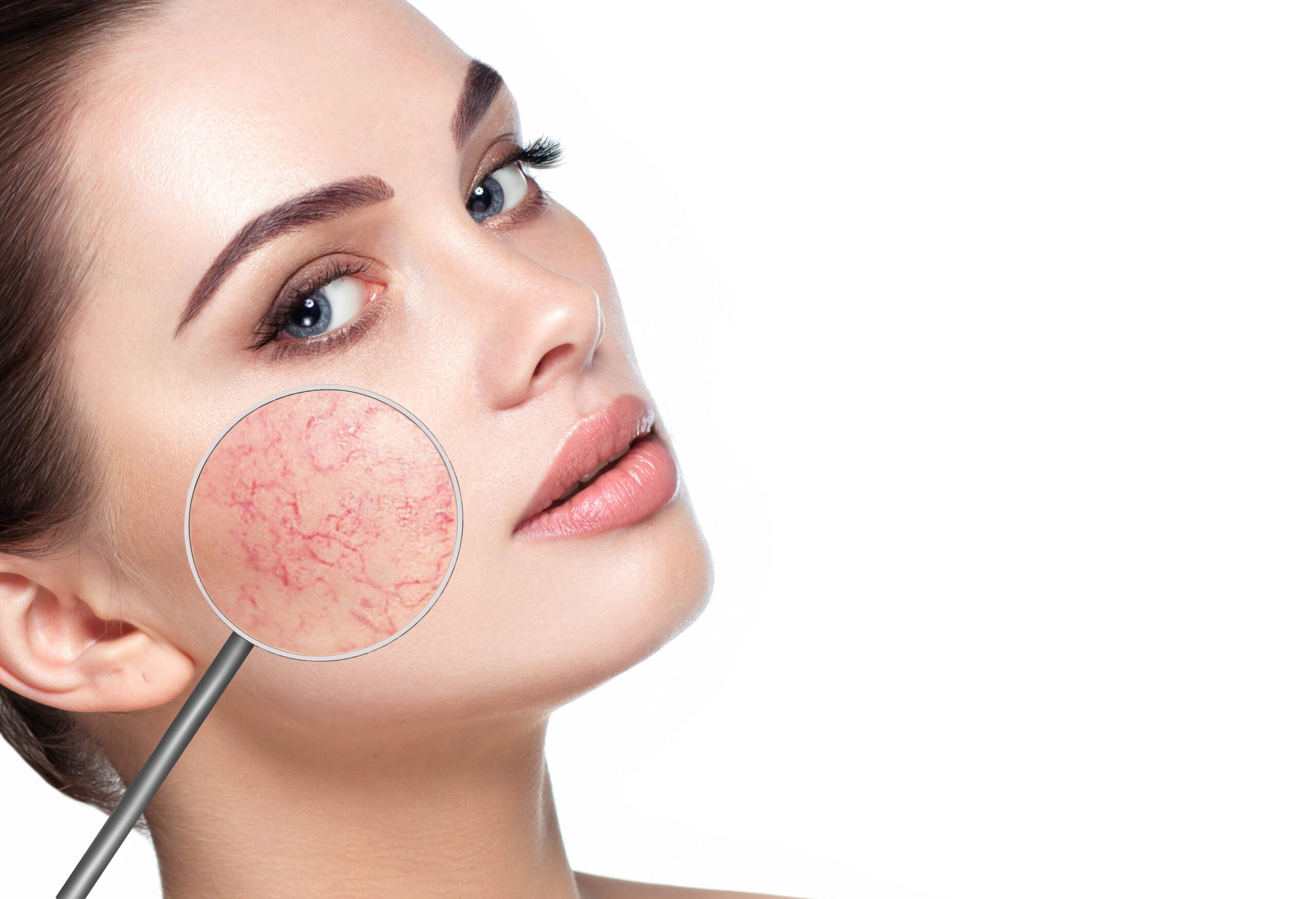 Laser Treatment for Rosacea: What to Know